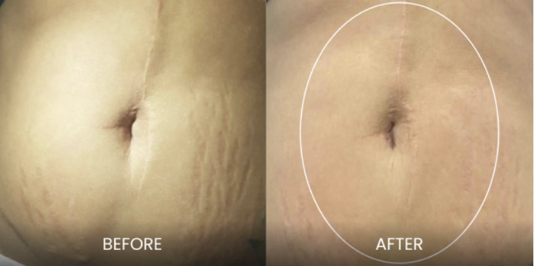 STRETCH MARKS Microneedling